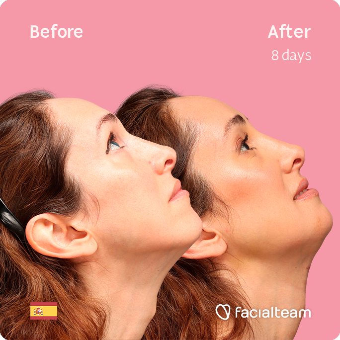 Square side up image of FFS patient Sara L showing the results before-after FFS with Facialteam of forehead, traquea shave and chin feminization surgery.