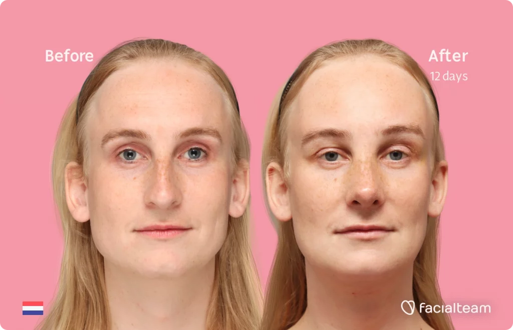 Frontal image of FFS patient Yvette showing the results before-after with Facialteam consisting of forehead, rhinoplasty, tracheal shave and chin feminization surgery. View now.