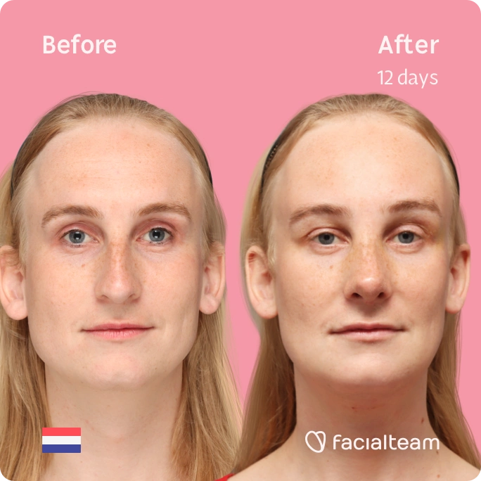 Square frontal image of FFS patient Yvette showing the results before-after with Facialteam consisting of forehead, rhinoplasty, tracheal shave and chin feminization surgery. View now.