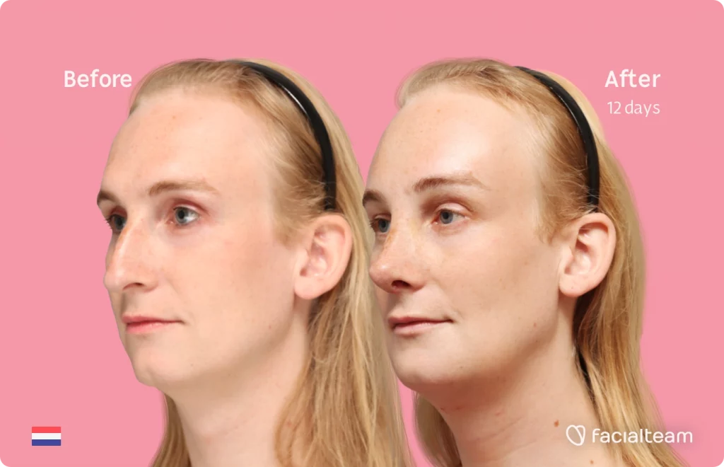 Angeled image of FFS patient Yvette showing the results before-after with Facialteam consisting of forehead, rhinoplasty, tracheal shave and chin feminization surgery. View now.