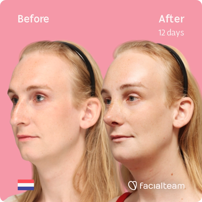 Square angeled image of FFS patient Yvette showing the results before-after with Facialteam consisting of forehead, rhinoplasty, tracheal shave and chin feminization surgery. View now.