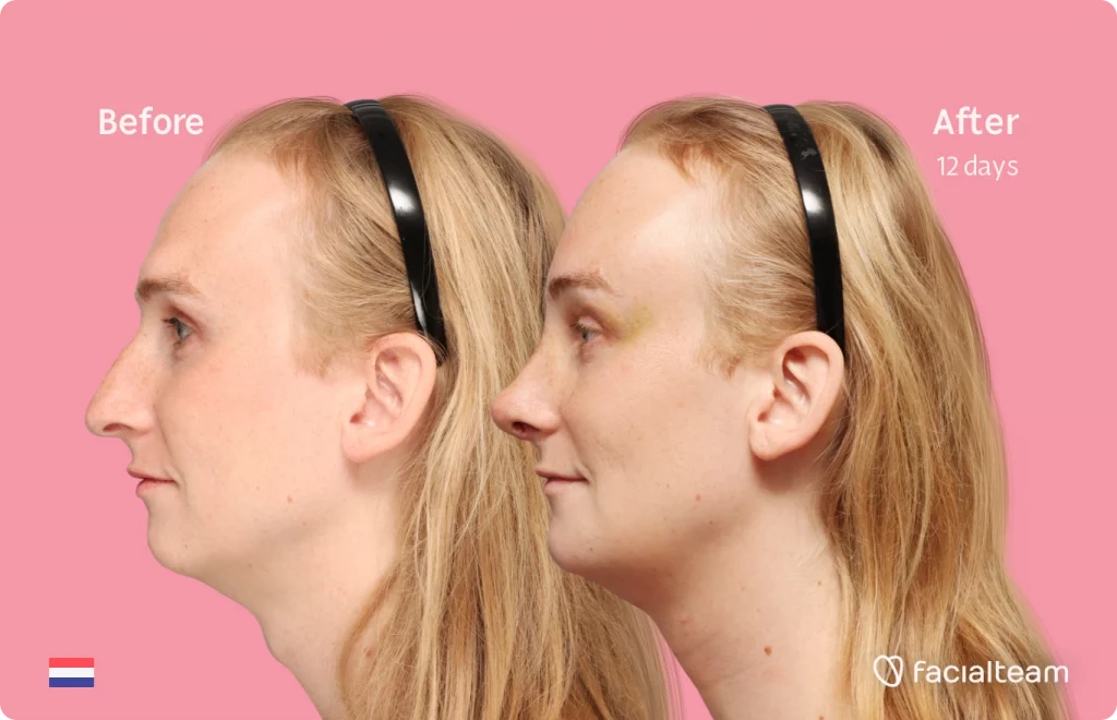 Side image of FFS patient Yvette showing the results before-after with Facialteam consisting of forehead, rhinoplasty, tracheal shave and chin feminization surgery. View now.