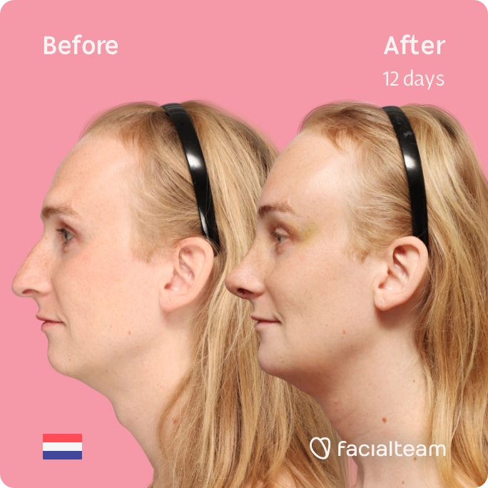 Square side image of FFS patient Yvette showing the results before-after with Facialteam consisting of forehead, rhinoplasty, tracheal shave and chin feminization surgery. View now.