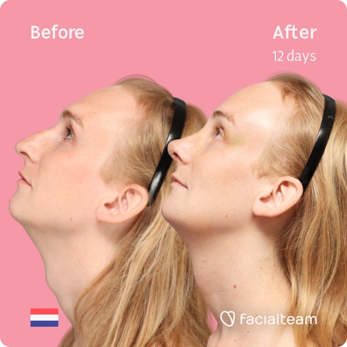 Square side up image of FFS patient Yvette showing the results before-after with Facialteam consisting of forehead, rhinoplasty, tracheal shave and chin feminization surgery. View now.