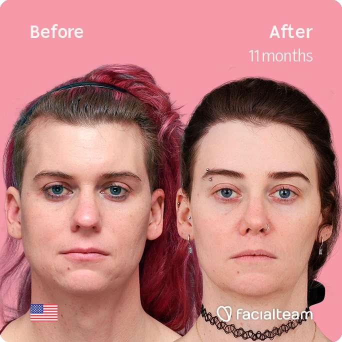 Square frontal image of FFS patient Taryn showing the results before-after with Facialteam consisting of forehead with SHT, rhinoplasty, lip and chin feminization surgery. View now.