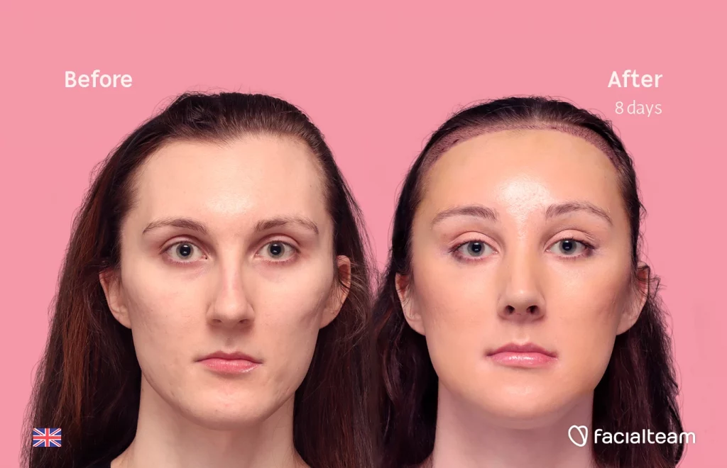Frontal image of FFS patient Lynne showing the results before-after with Facialteam consisting of forehead with SHT, rhinoplasty, jaw and chin feminization surgery. View now.