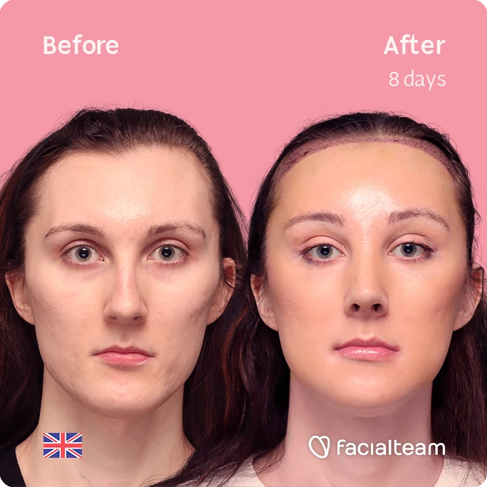 Square frontal image of FFS patient Lynne showing the results before-after with Facialteam consisting of forehead with SHT, rhinoplasty, jaw and chin feminization surgery. View now.
