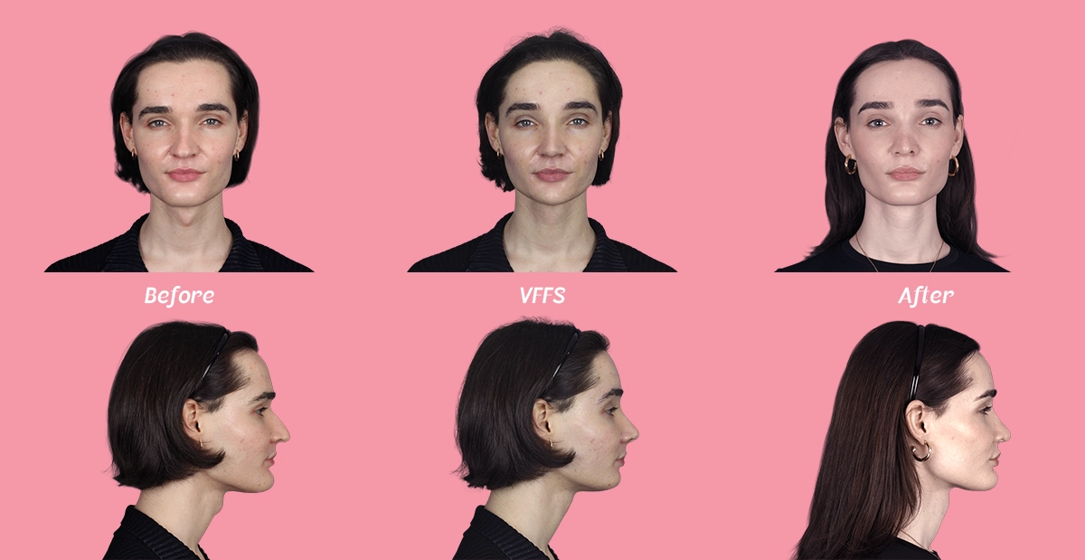 Example of a before, virtual FFS simulation and after of Facialteam's facial feminization surgery patient Negin