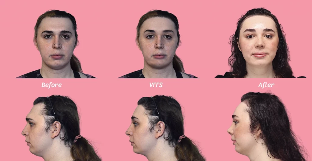 Example of a before, virtual FFS simulation and after of Facialteam's facial feminization surgery patient Kira S