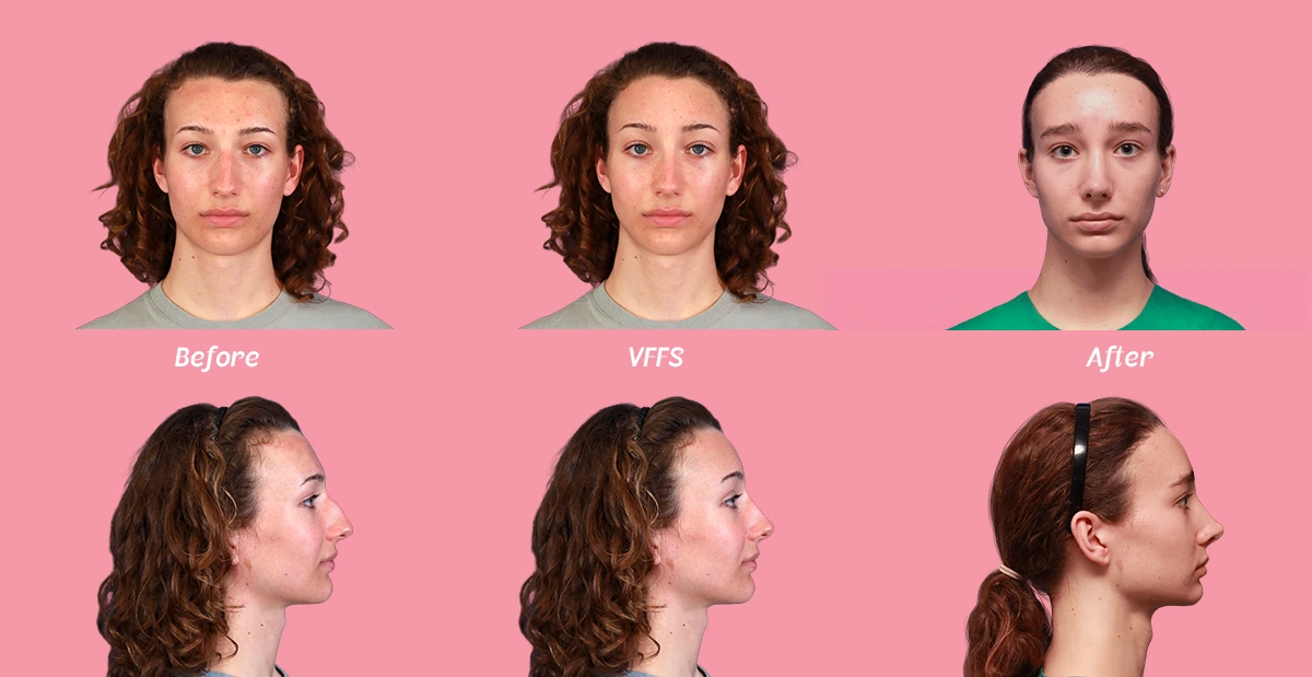 Example of a before, virtual FFS simulation and after of Facialteam's facial feminization surgery patient Amelia