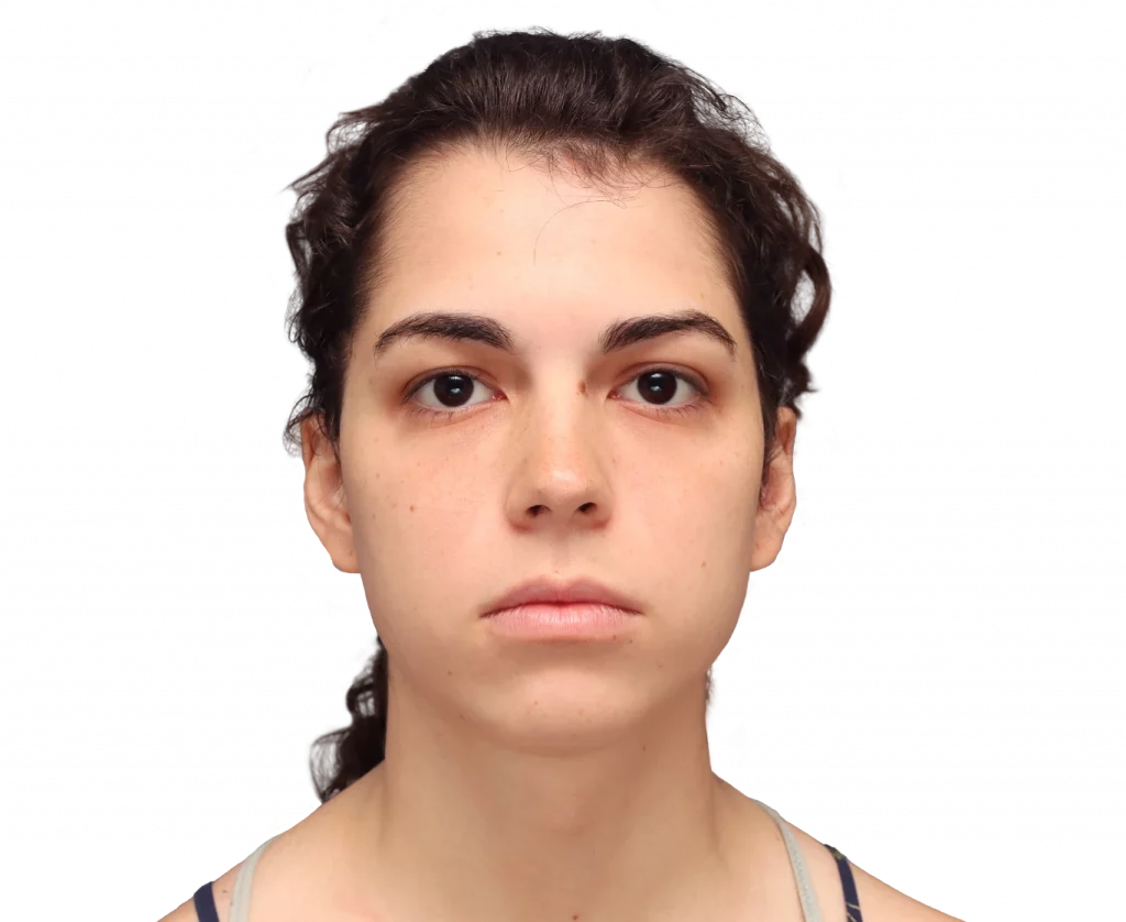 Frontal picture taken from Avery before surgery