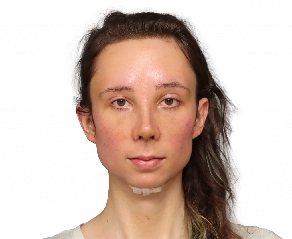 Frontal picture taken from Sasha after surgery