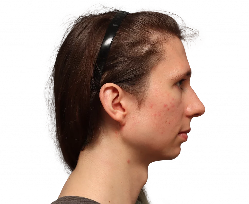 Side picture taken from Sasha before surgery