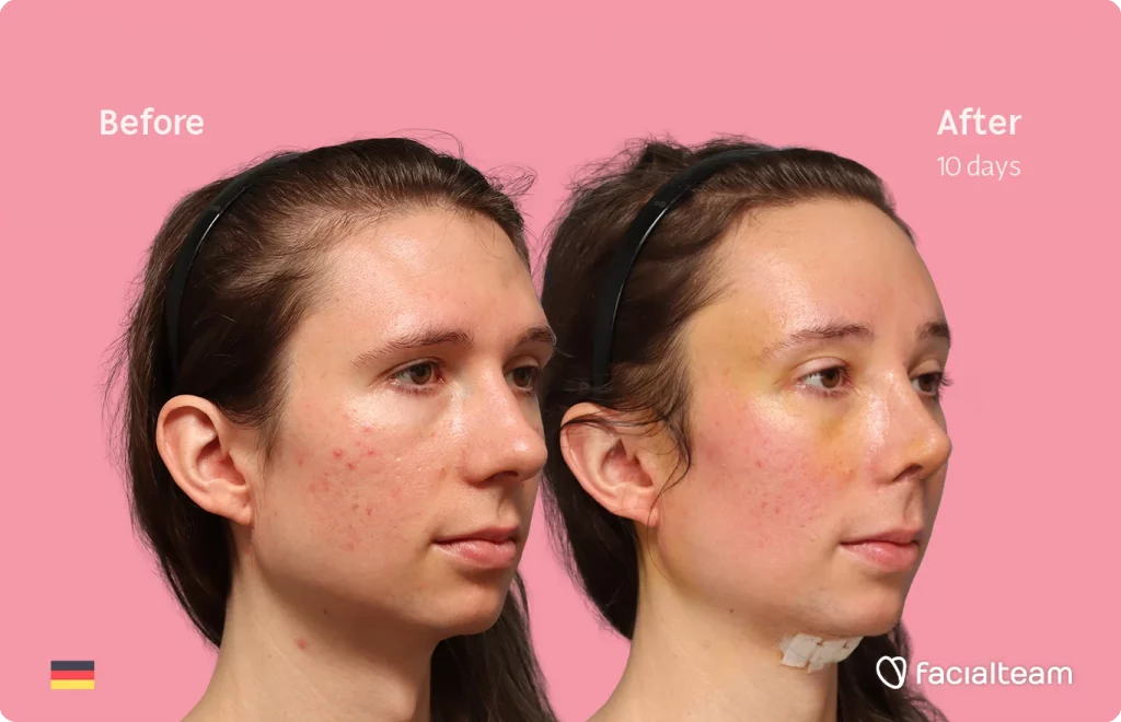 Angeled image of FFS patient Sasha showing the results before-after with Facialteam consisting of tracheal shave, forehead feminization surgery and rhinoplasty. View now.