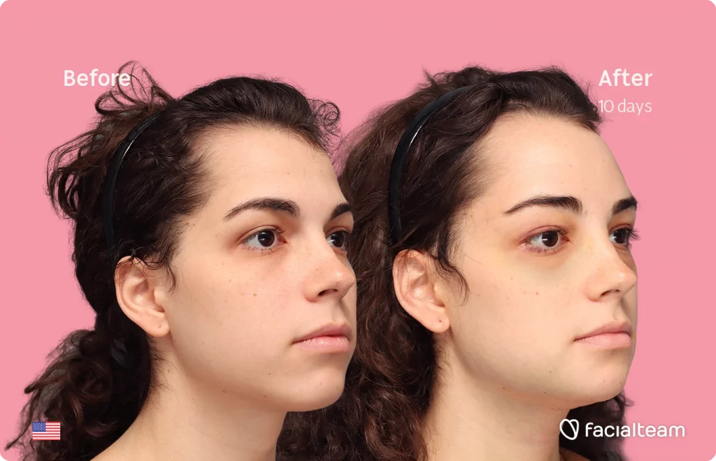Angeled image of FFS patient Avery showing the results before-after with Facialteam consisting of tracheal shave, forehead and chin feminization surgery. View now.