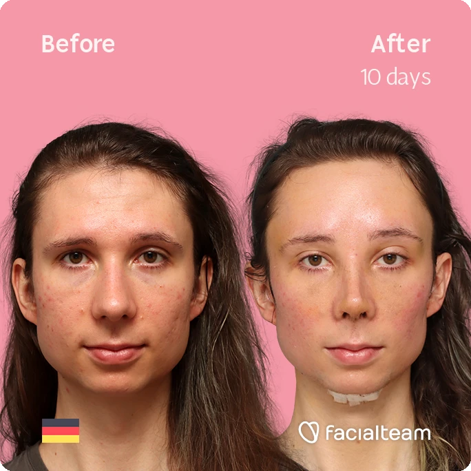 Square frontal image of FFS patient Sasha showing the results before-after with Facialteam consisting of tracheal shave, forehead feminization surgery and rhinoplasty. View now.