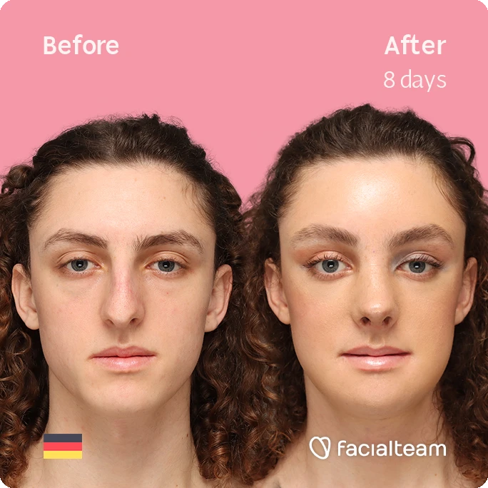 Square frontal image of FFS patient Eleanor showing the results before-after with Facialteam consisting of forehead, rhinoplasty, tracheal shave, hifu and chin feminization surgery.