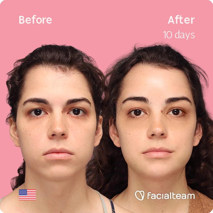 Square frontal image of FFS patient Avery showing the results before-after with Facialteam consisting of tracheal shave, forehead and chin feminization surgery. View now.