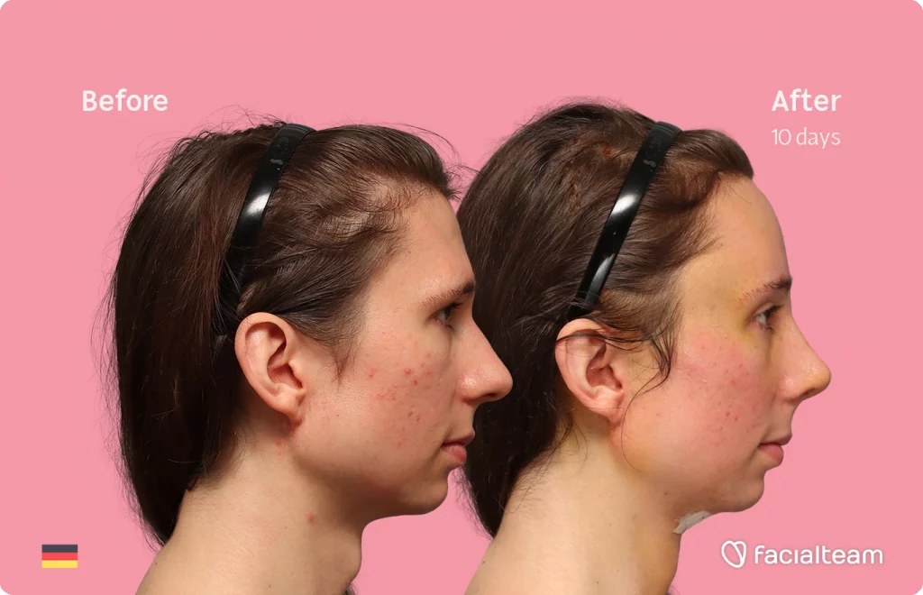 Side image of FFS patient Sasha showing the results before-after with Facialteam consisting of tracheal shave, forehead feminization surgery and rhinoplasty. View now.