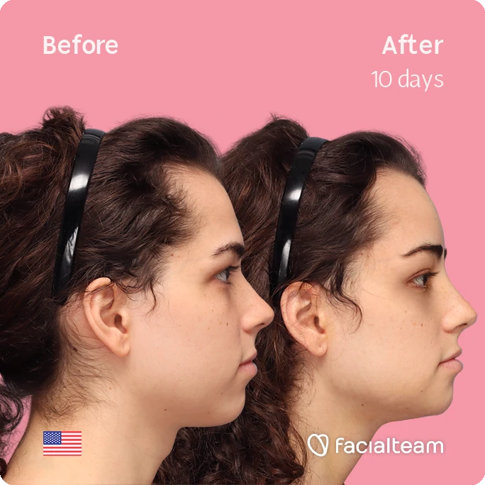 Square side image of FFS patient Avery showing the results before-after with Facialteam consisting of tracheal shave, forehead and chin feminization surgery. View now.