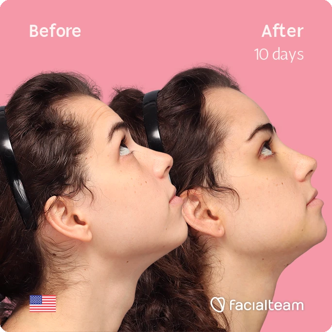 Square side up image of FFS patient Avery showing the results before-after with Facialteam consisting of tracheal shave, forehead and chin feminization surgery. View now.