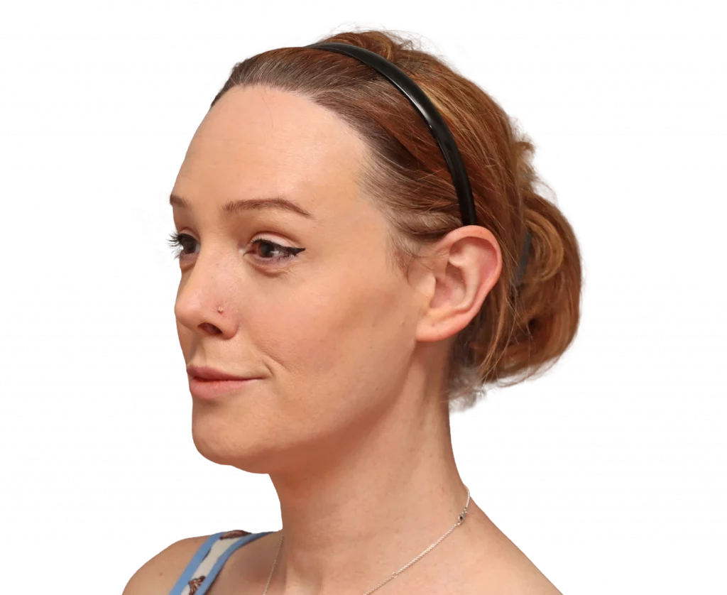 Angled left profile photo of Kezia after surgery.