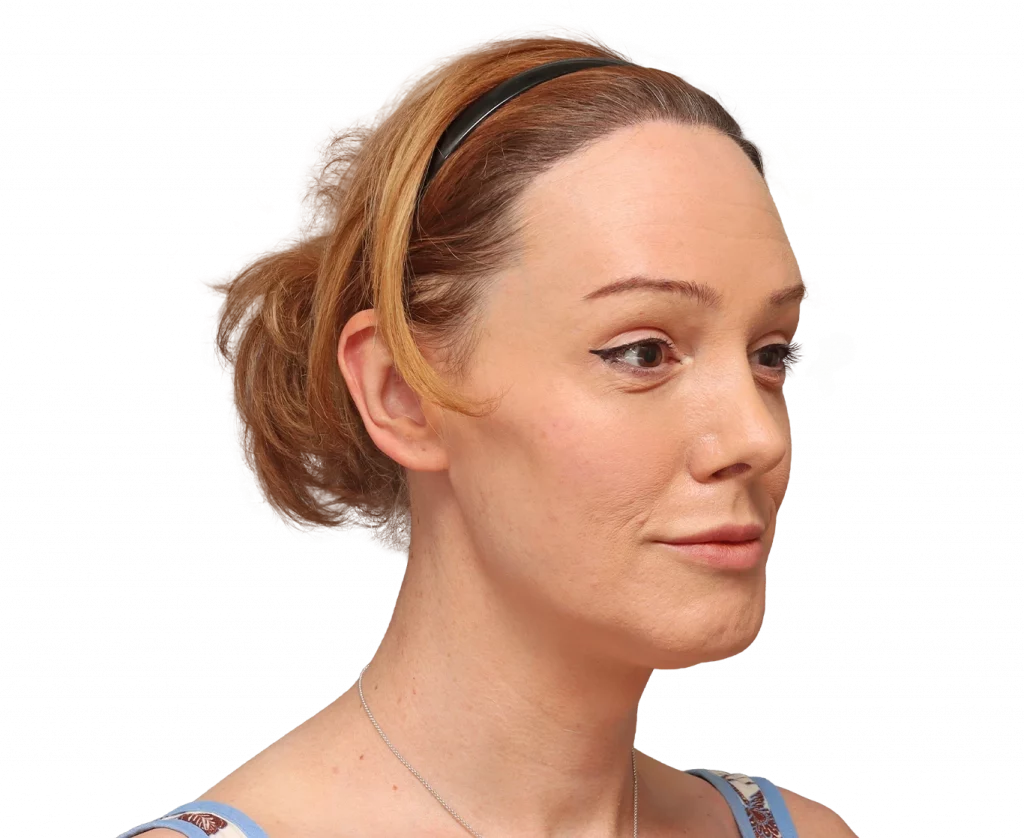 Angled right profile photo of Kezia after surgery.