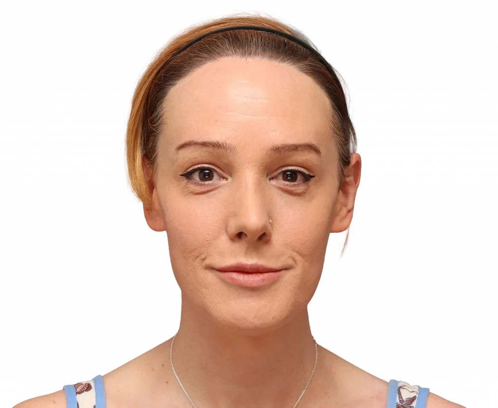 Frontal profile photo of Kezia after surgery.