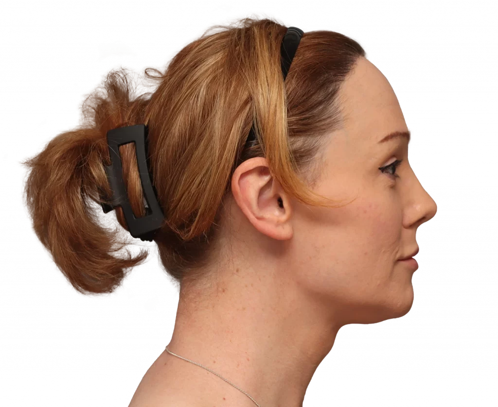 Side right profile photo of Kezia after surgery.