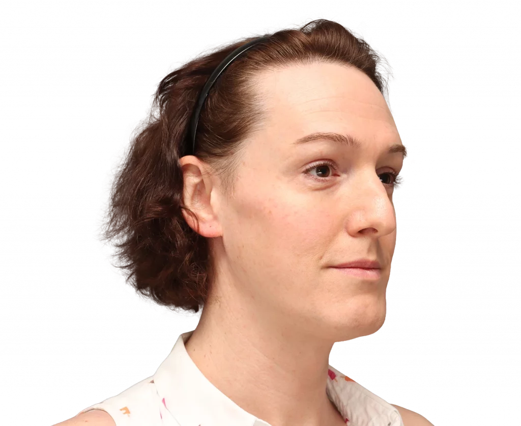 Angled right profile photo of Kezia before surgery.