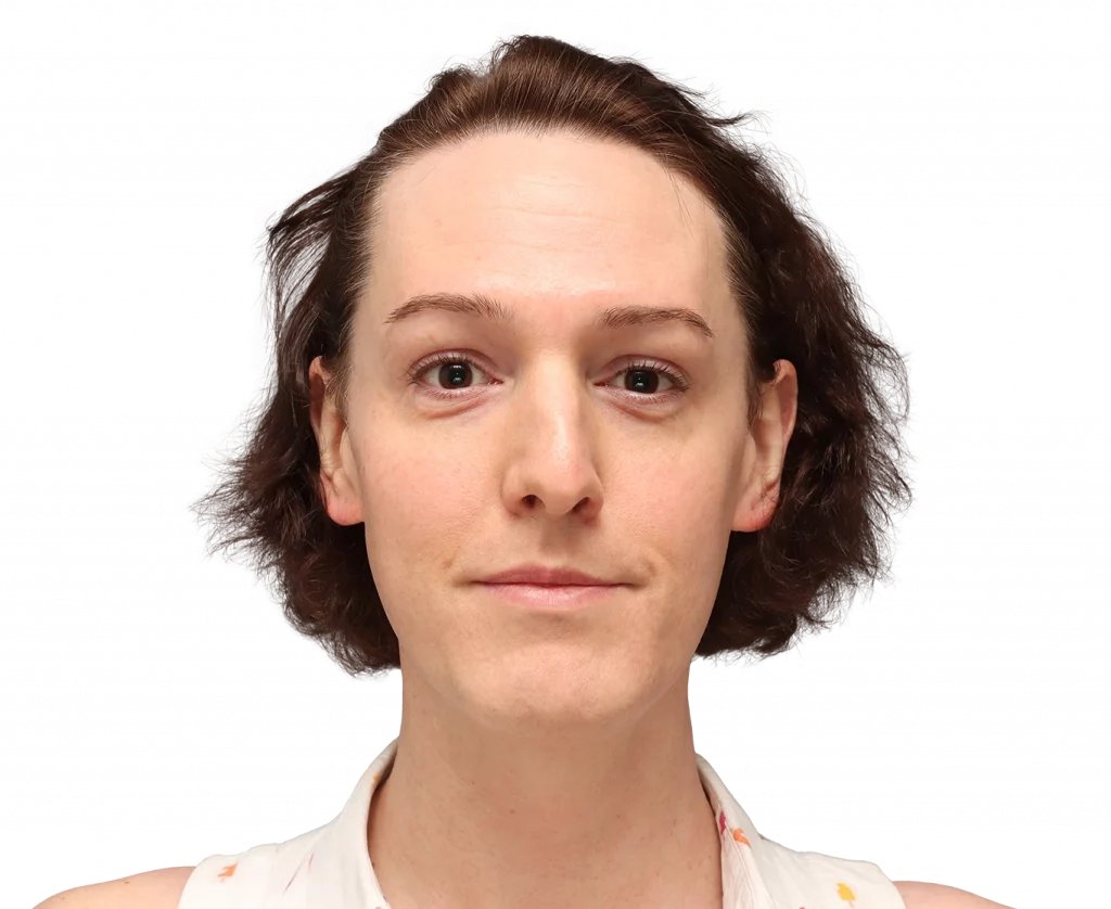 Frontal profile photo of Kezia before surgery.