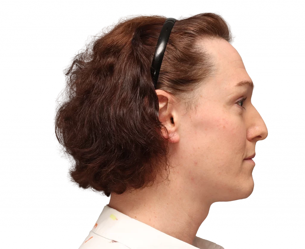 Side left profile photo of Kezia before surgery.