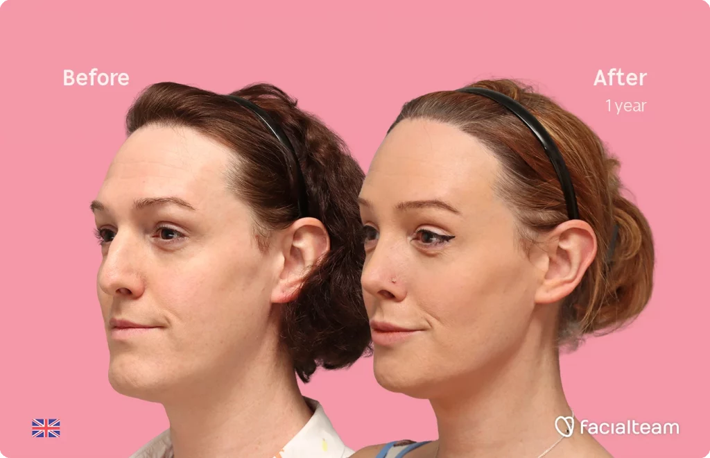 Angled left image of FFS patient Kezia showing the results before-after with Facialteam consisting of Forehead with SHT, rhinoplasty, chin Feminization, HIFU and Lip Feminization surgery as complementary procedure.
