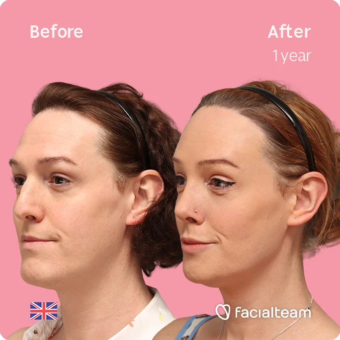 Angled left square image of FFS patient Kezia showing the results before-after with Facialteam consisting of Forehead with SHT, rhinoplasty, chin Feminization, HIFU and Lip Feminization surgery as complementary procedure.
