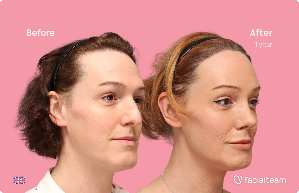 Angled right image of FFS patient Kezia showing the results before-after with Facialteam consisting of Forehead with SHT, rhinoplasty, chin Feminization, HIFU and Lip Feminization surgery as complementary procedure.