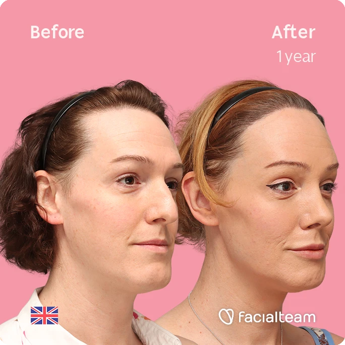 Angled right square image of FFS patient Kezia showing the results before-after with Facialteam consisting of Forehead with SHT, rhinoplasty, chin Feminization, HIFU and Lip Feminization surgery as complementary procedure.