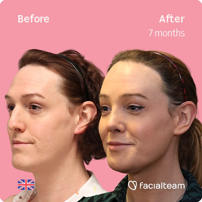 Angeled square image of FFS patient Kezia showing the results before-after with Facialteam consisting of forehead with simultaneous hair transplant, rhinoplasty and chin feminization surgery.