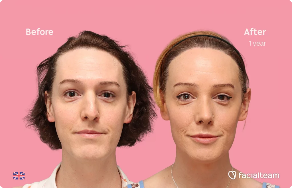 Frontal image of FFS patient Kezia showing the results before-after with Facialteam consisting of Forehead with SHT, rhinoplasty, chin Feminization, HIFU and Lip Feminization surgery as complementary procedure.
