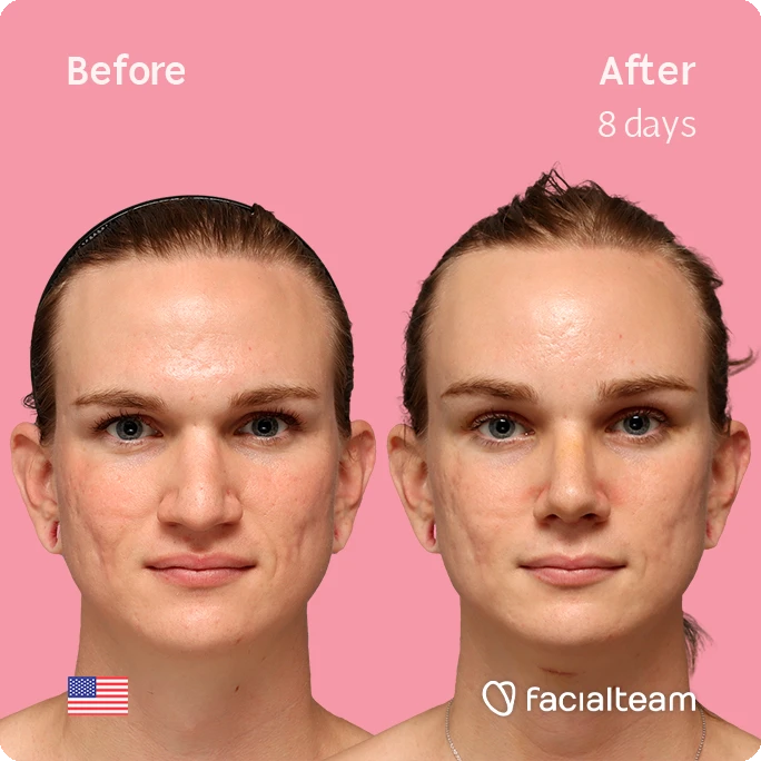 Frontal square image of FFS patient Es showing the results before-after with Facialteam consisting of forehead, rhinoplasty and tracheal shave feminization surgery.