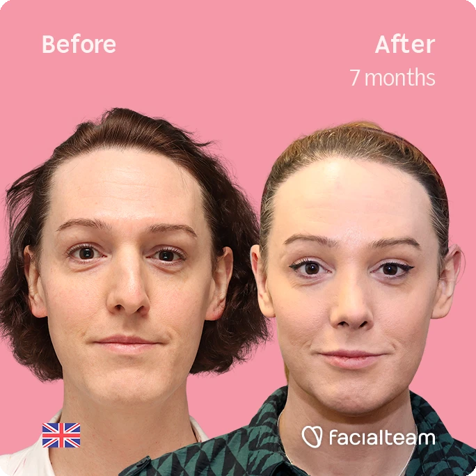 Frontal square image of FFS patient Kezia showing the results before-after with Facialteam consisting of forehead with simultaneous hair transplant, rhinoplasty and chin feminization surgery.