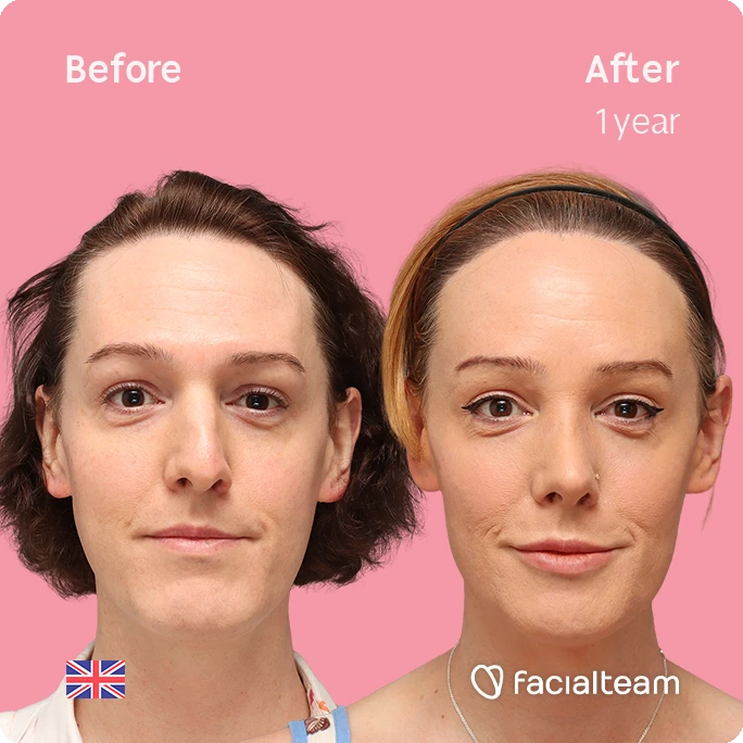 Frontal square image of FFS patient Kezia showing the results before-after with Facialteam consisting of Forehead with SHT, rhinoplasty, chin Feminization, HIFU and Lip Feminization surgery as complementary procedure.