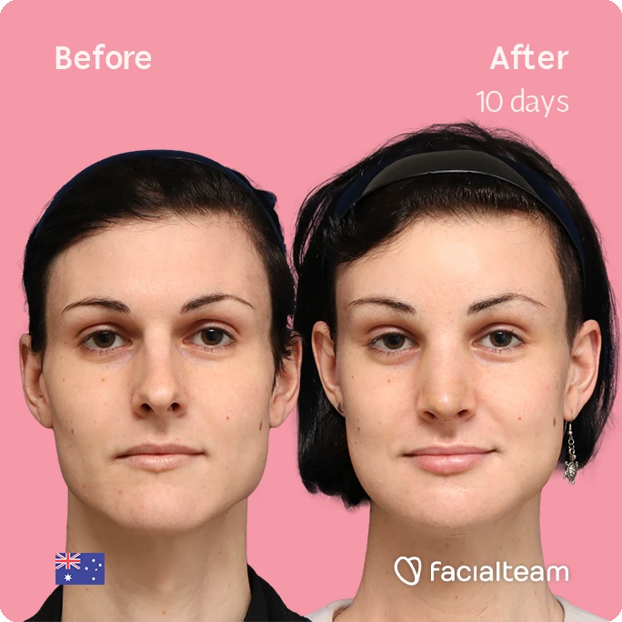 Square frontal image of FFS patient Grace H showing the results before-after with Facialteam consisting of forehead, rhinoplasty, tracheal shave, jaw and chin feminization surgery.