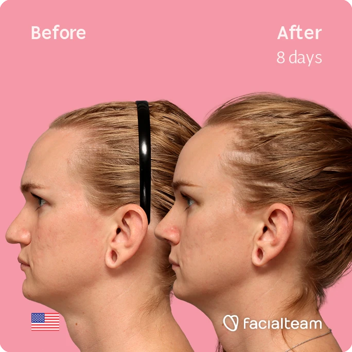 Side square image of FFS patient Es showing the results before-after with Facialteam consisting of forehead, rhinoplasty and tracheal shave feminization surgery.