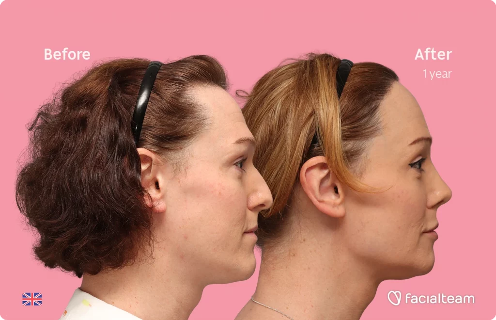 Side right image of FFS patient Kezia showing the results before-after with Facialteam consisting of Forehead with SHT, rhinoplasty, chin Feminization, HIFU and Lip Feminization surgery as complementary procedure.