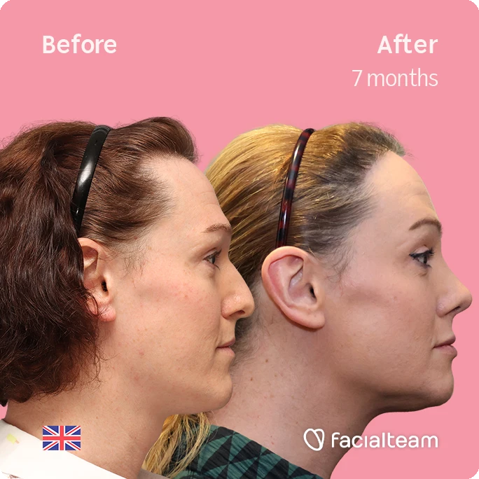 Side square image of FFS patient Kezia showing the results before-after with Facialteam consisting of forehead with simultaneous hair transplant, rhinoplasty and chin feminization surgery.