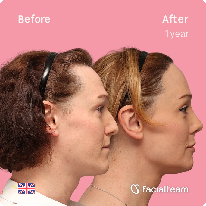 Side right image of FFS patient Kezia showing the results before-after with Facialteam consisting of Forehead with SHT, rhinoplasty, chin Feminization, HIFU and Lip Feminization surgery as complementary procedure.