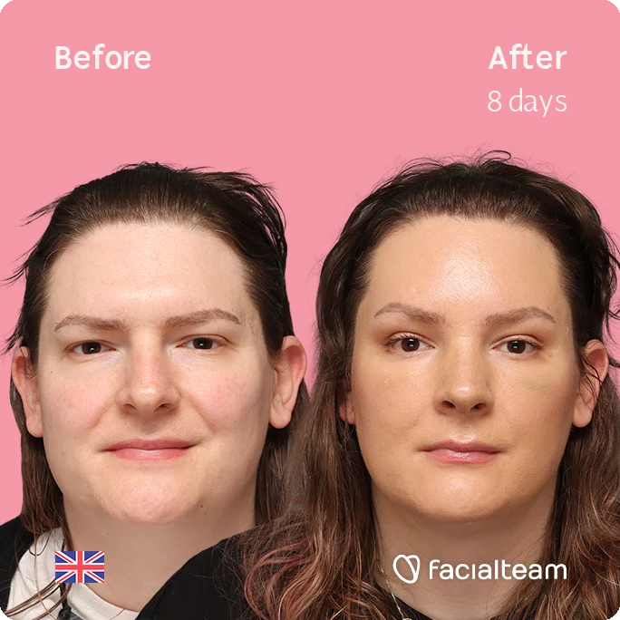 Frontal square image of FFS patient Chris showing the results before-after with Facialteam consisting of forehead, and rhinoplasty feminization surgery.