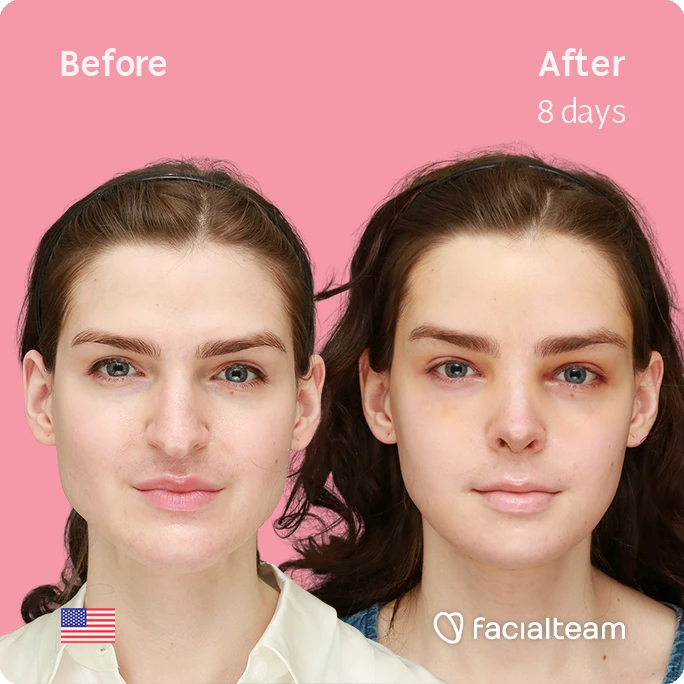 Frontal square image of FFS patient Sylvia showing the results before-after with Facialteam consisting of forehead, rhinoplasty, tracheal shave and chin feminization surgery.