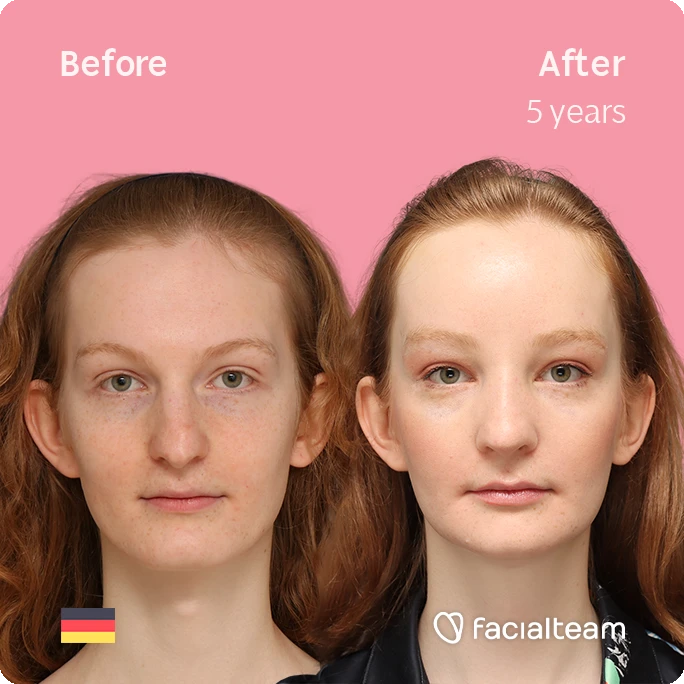Frontal square image of FFS patient Sanja showing the results before-after with Facialteam consisting of forehead, rhinoplasty, tracheal shave and chin feminization surgery.