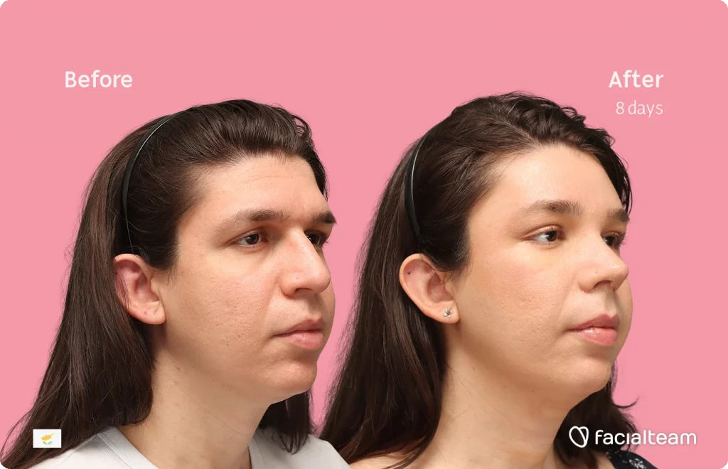 Angeled image of FFS patient Rhea showing the results before-after with Facialteam consisting of forehead, rhinoplasty, and tracheal shave feminization surgery.